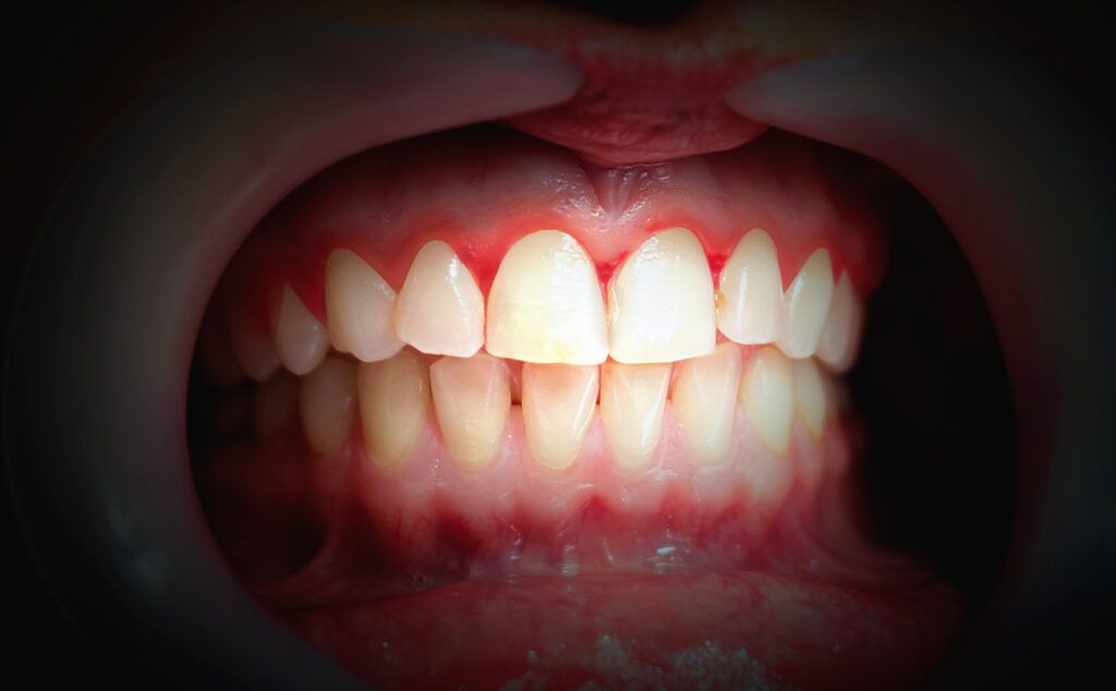 Wat betekent bloedend tandvlees? Tips van de expert