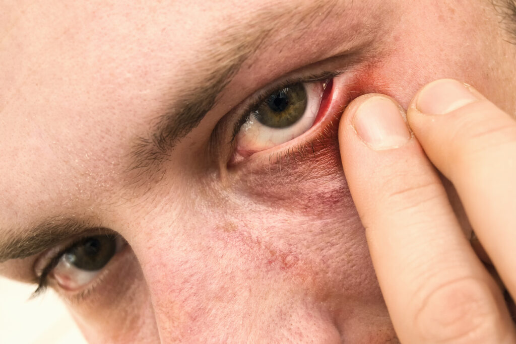 Gezwollen ooglid: oorzaak, symptomen en tips