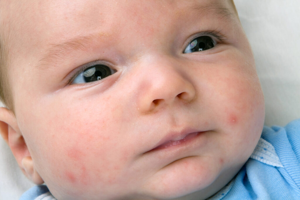 Baby acne: Oorzaken & Behandeling