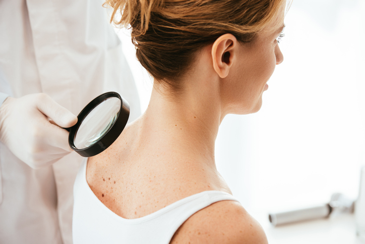 Leuvense onderzoekers ontdekken potentiële behandeling tegen huidkanker