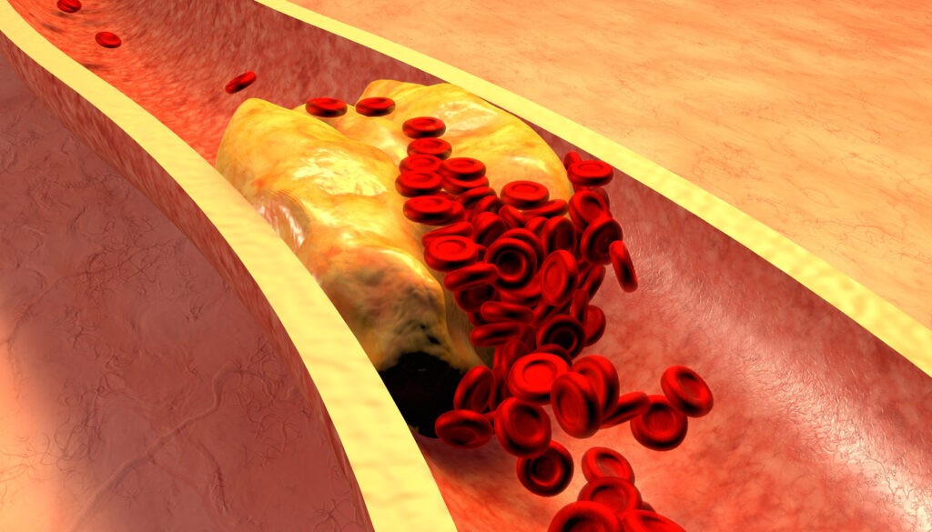 Experts aan het woord: zo kunnen we onze cholesterol verminderen