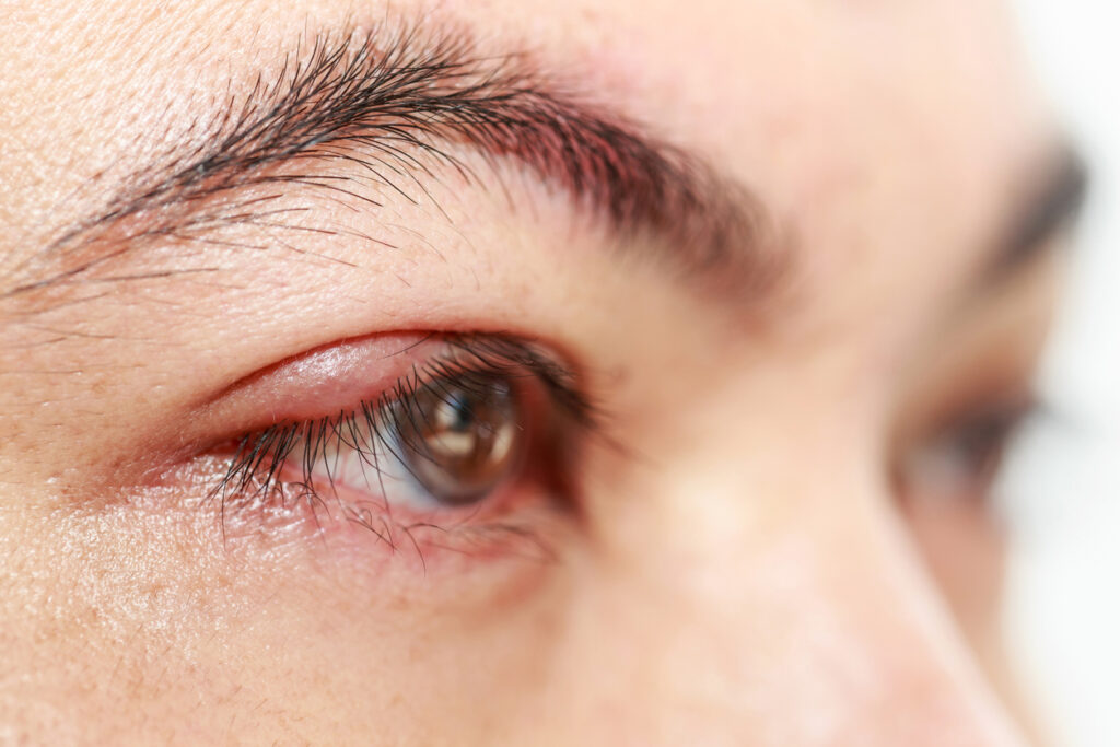 Gezwollen ooglid of oogleden? Dit kun je doen