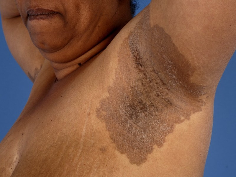 Infectie van de huid: Erythrasma (Corynebacterium minutissimum)