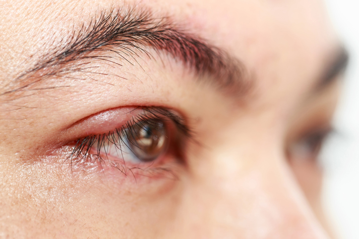 Ontstoken oogleden: Blefaritis – Blepharitis