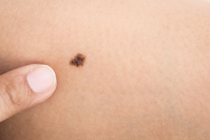 Wat is een melanoom en hoe herken ik de symptomen?