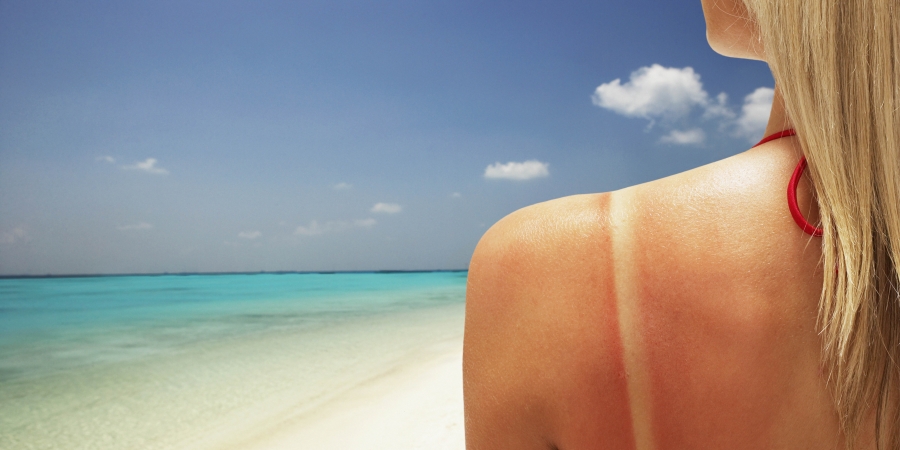 Zorgeloze zomer: 6 X Dit doe je als je huid verbrand is